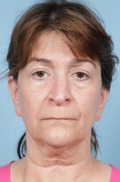Facelift before at John Kim, MD, FACS in Chicago, IL