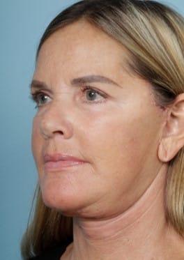 Facelift after at John Kim, MD, FACS in Chicago, IL