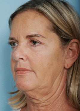 Facelift before at John Kim, MD, FACS in Chicago, IL