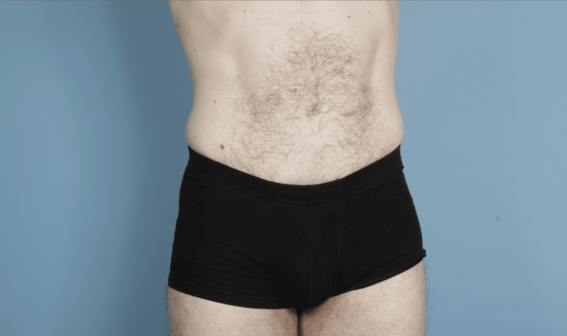 Tummy Tuck result at John Kim, MD, FACS in Chicago, IL