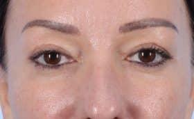 Blepharoplasty after at John Kim, MD, FACS in Chicago, IL
