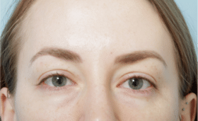 Blepharoplasty before at John Kim, MD, FACS in Chicago, IL