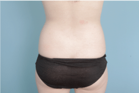Brazilian Butt Lift before at John Kim, MD, FACS in Chicago, IL