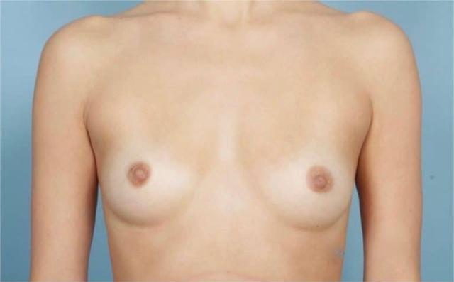 Breast Augmentation before at John Kim, MD, FACS in Chicago, IL