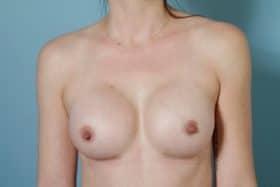 Breast Augmentation after at John Kim, MD, FACS in Chicago, IL