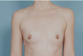 Breast Augmentation before at John Kim, MD, FACS in Chicago, IL