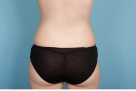 Brazilian Butt Lift after at John Kim, MD, FACS in Chicago, IL