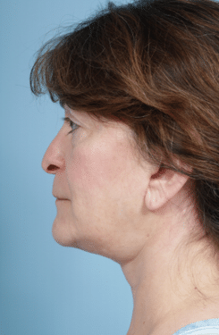 Facelift after at John Kim, MD, FACS in Chicago, IL