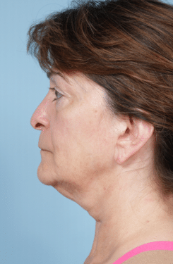 Facelift before at John Kim, MD, FACS in Chicago, IL