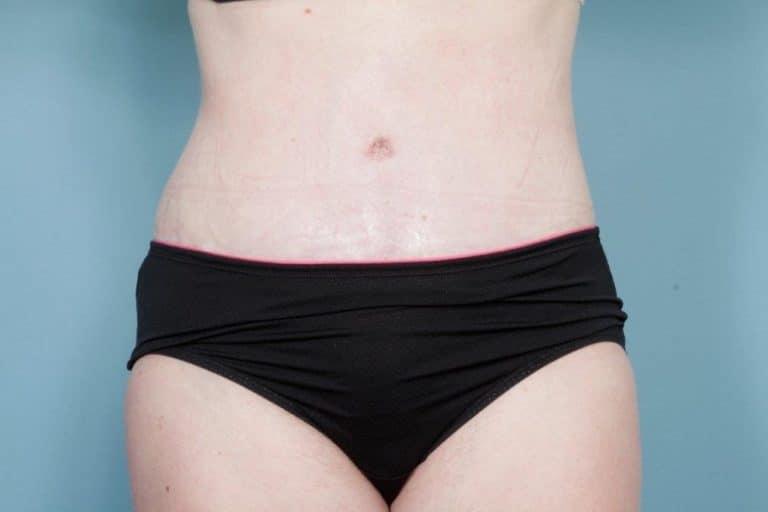 John Kim, MD, FACS tummy tuck after — Chicago, IL