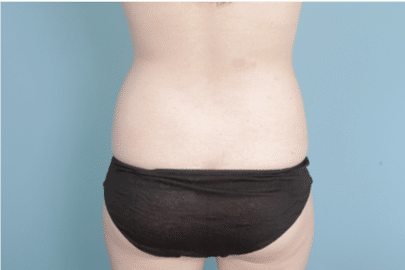 Liposuction before at John Kim, MD, FACS in Chicago, IL