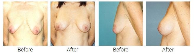 Richard Swift, MD breast lift result — New York, NY