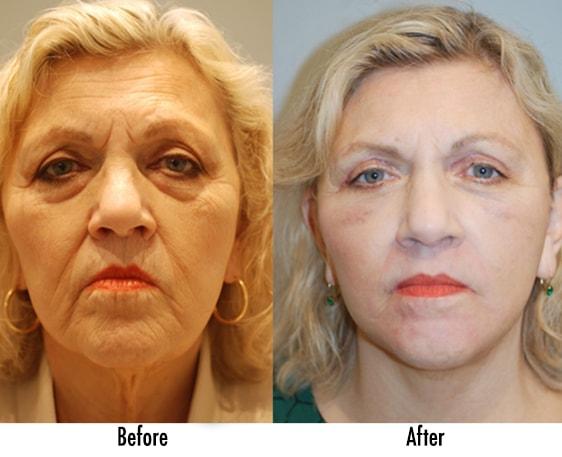Richard Swift, MD facelift result — New York, NY