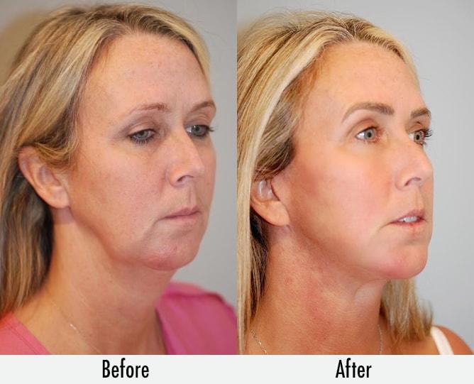 Richard Swift, MD facelift result — New York, NY