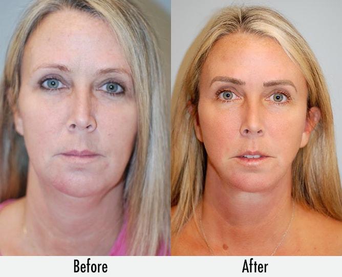 Richard Swift, MD facelift result — New York, NY