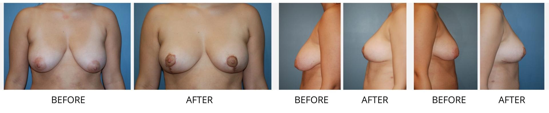 Richard Swift, MD breast lift result — New York, NY