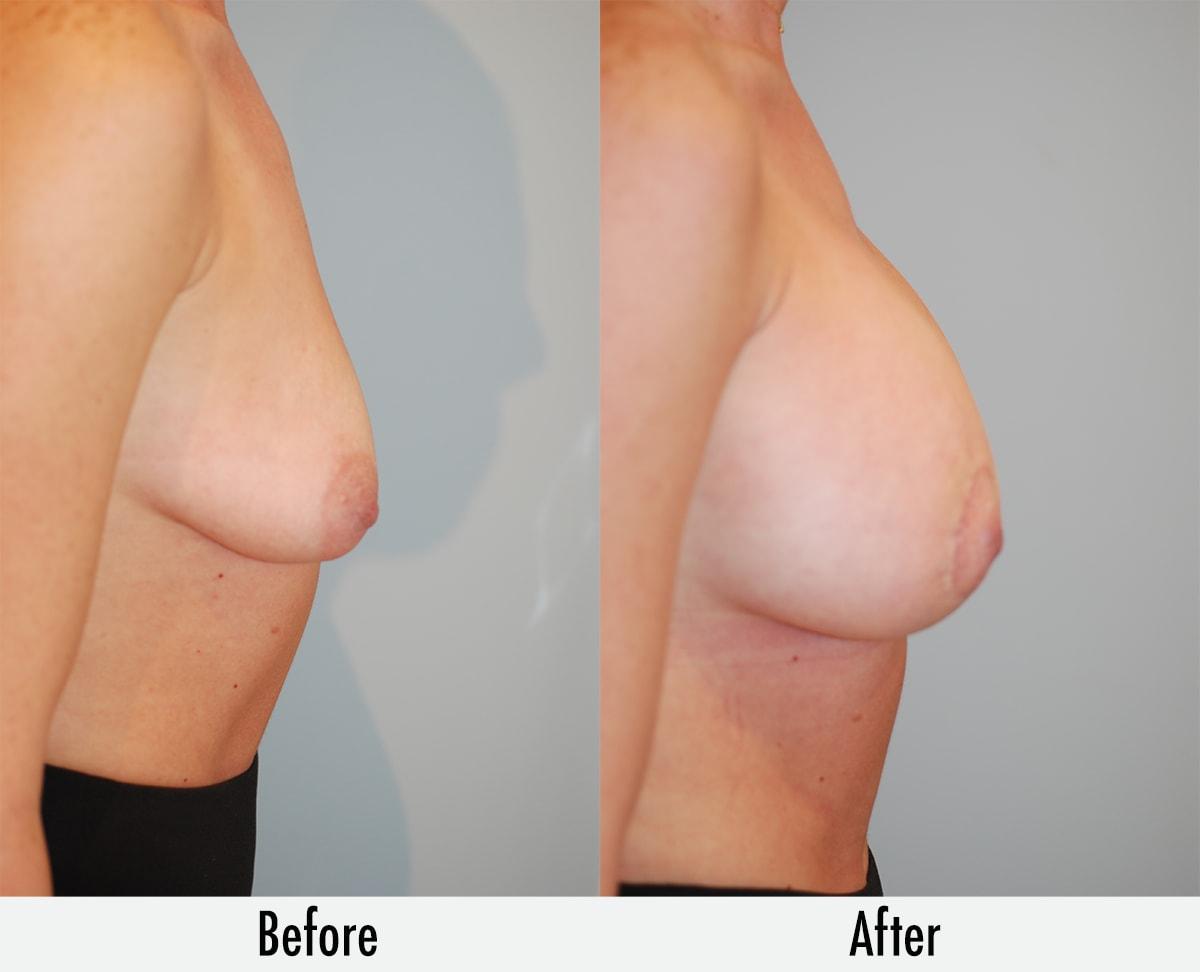 Richard Swift, MD breast lift result — New York, NY