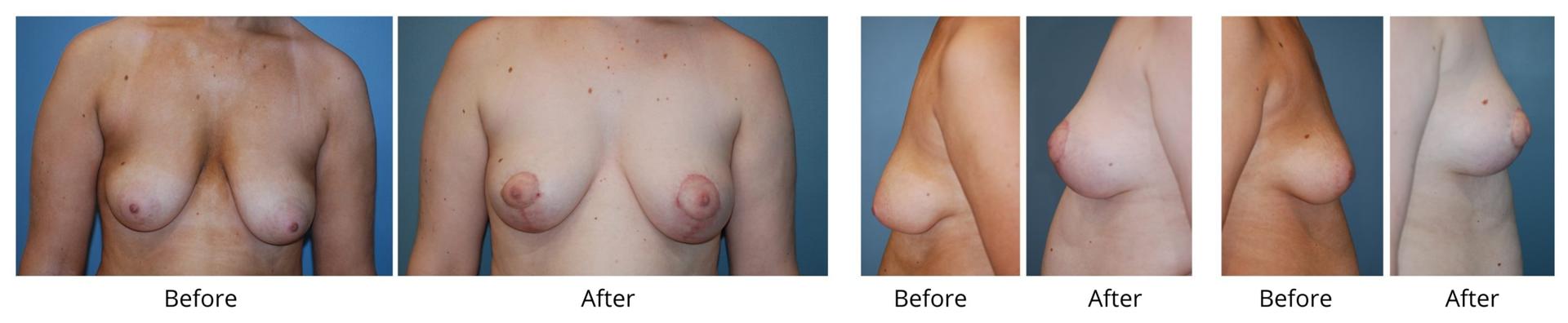 Richard Swift, MD breast lift result — New York, NY