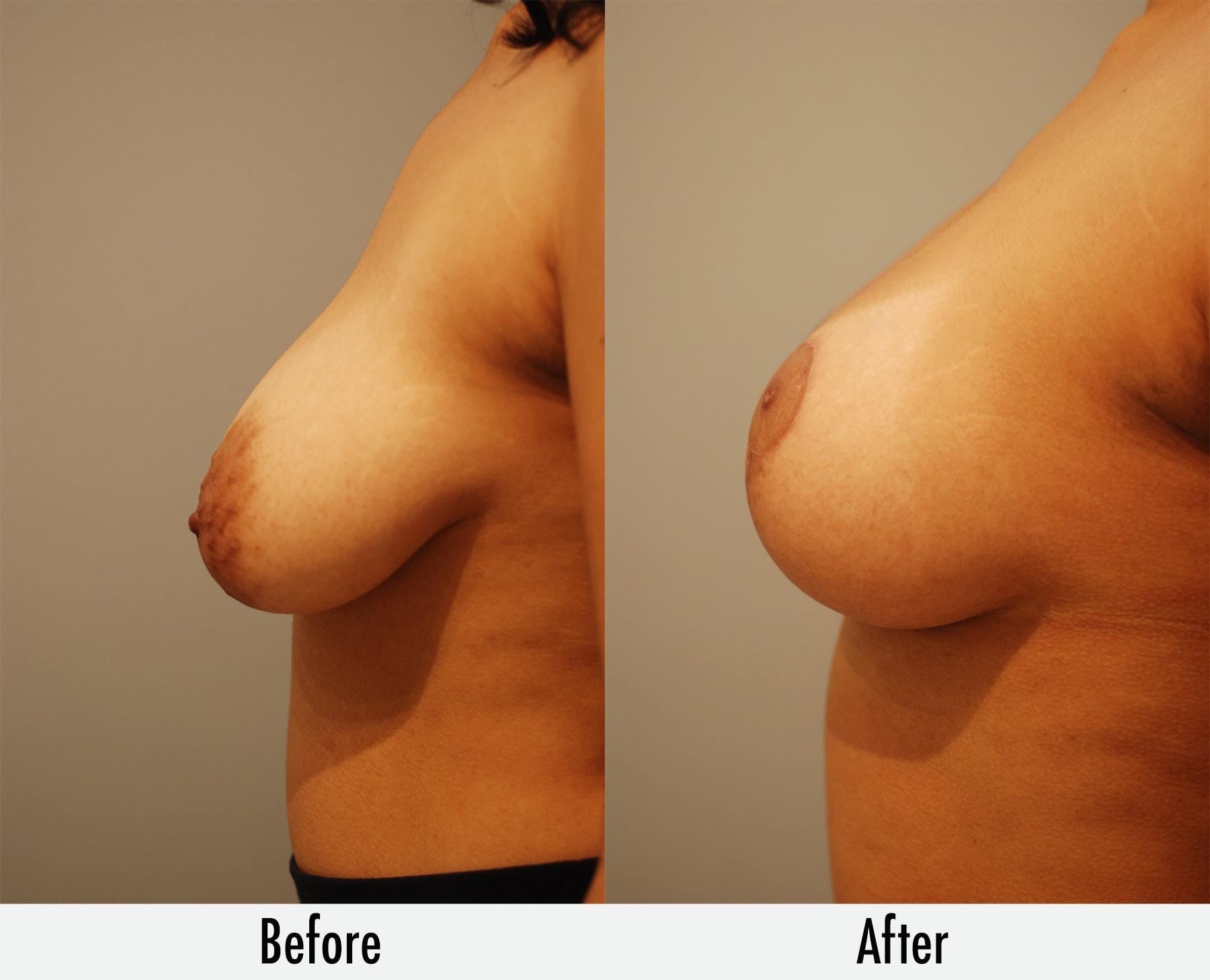 Richard Swift, MD breast lift result — New York, NY