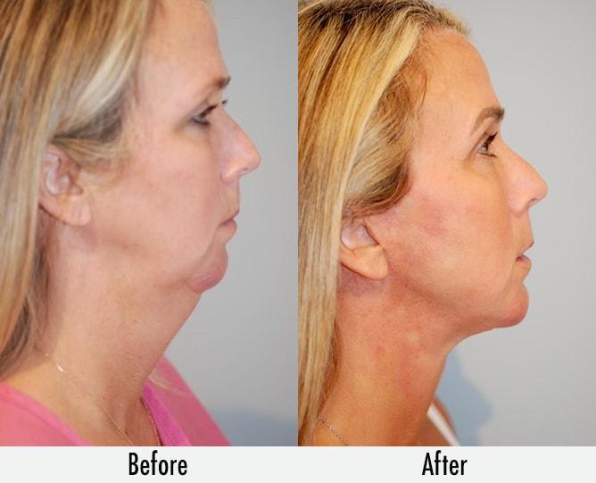 Richard Swift, MD facelift result — New York, NY