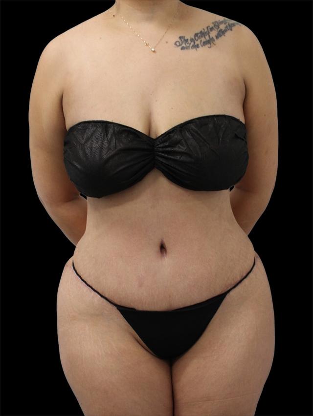 Mini Tummy Tuck after at NY Surgical Arts (Gordon Andan, MD) in Garden City, NY