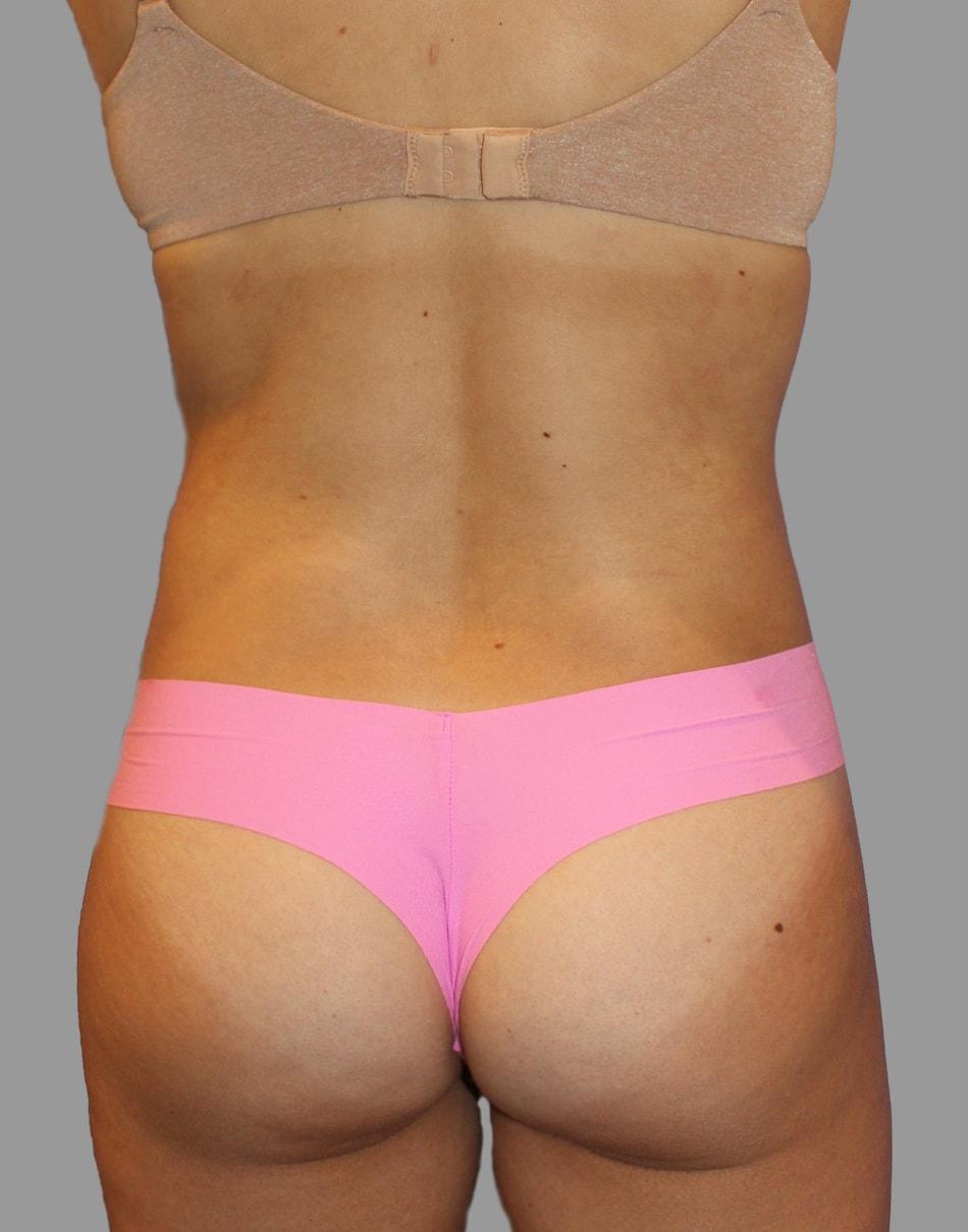 NY Surgical Arts (Gordon Andan, MD) liposuction after — Garden City, NY