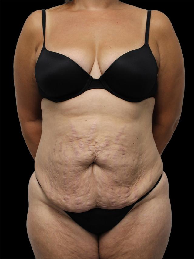 Mini Tummy Tuck before at NY Surgical Arts (Gordon Andan, MD) in Garden City, NY