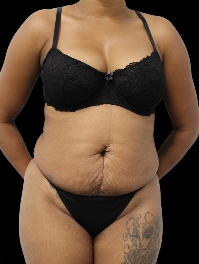 Mini Tummy Tuck before at NY Surgical Arts (Gordon Andan, MD) in Garden City, NY