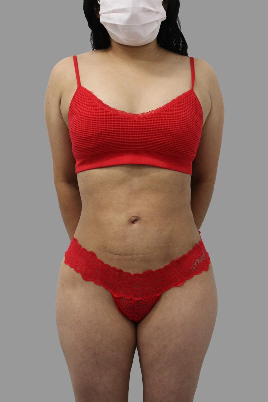 NY Surgical Arts (Gordon Andan, MD) liposuction after — Garden City, NY