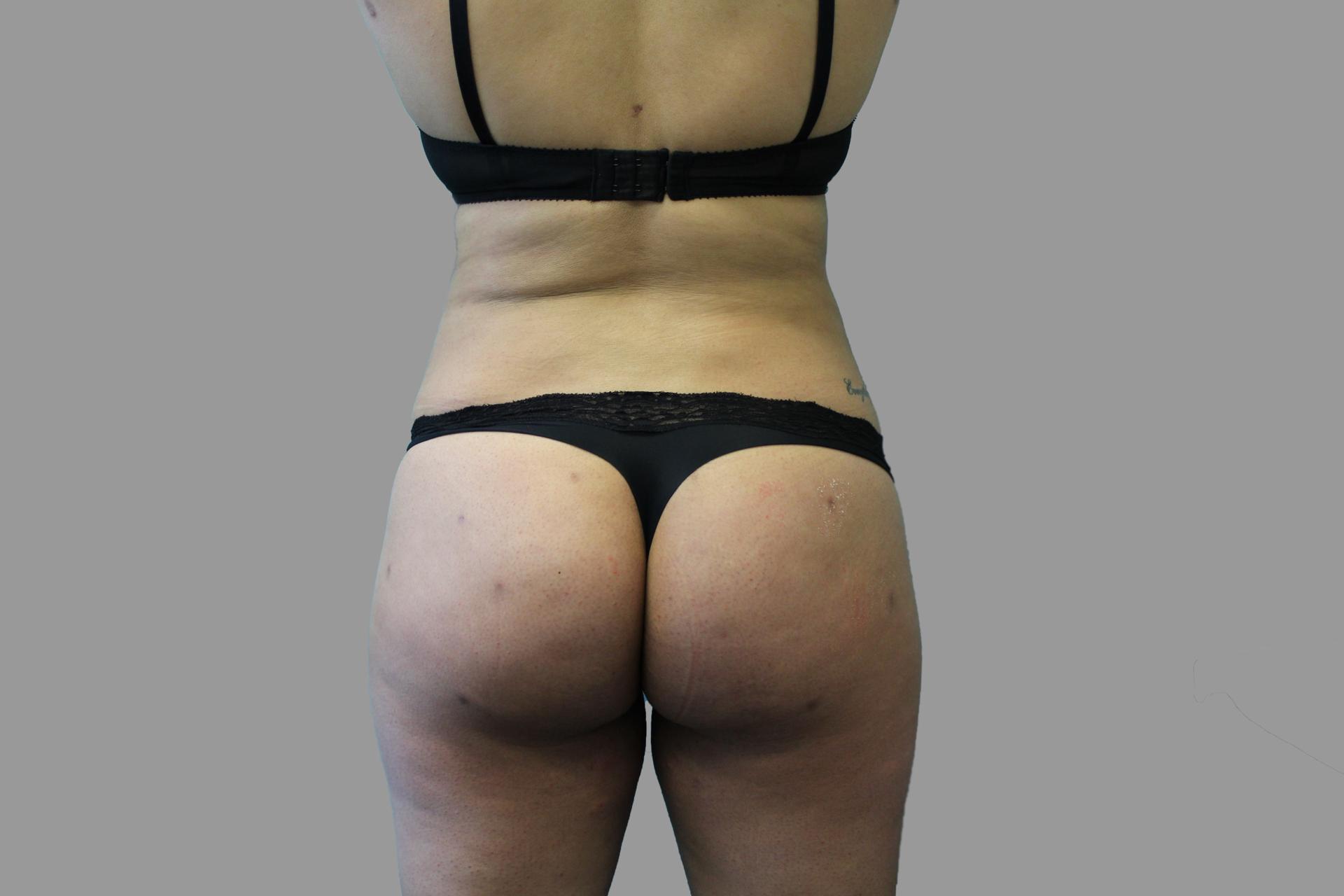 NY Surgical Arts (Gordon Andan, MD) bbl after — Garden City, NY