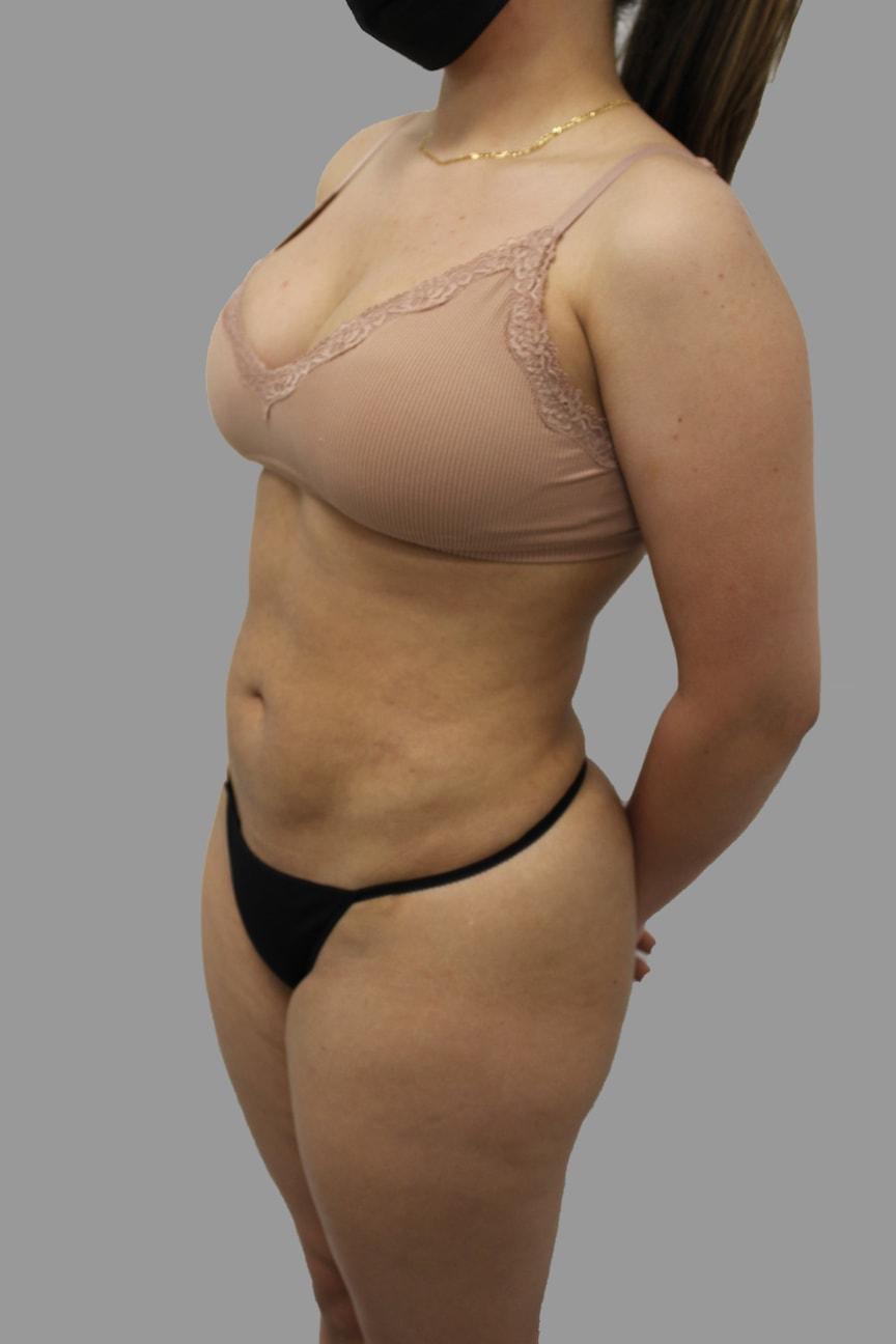 NY Surgical Arts (Gordon Andan, MD) liposuction after — Garden City, NY