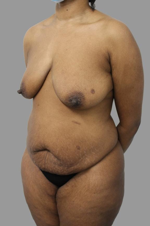 Mommy Makeover before at NY Surgical Arts (Gordon Andan, MD) in Garden City, NY
