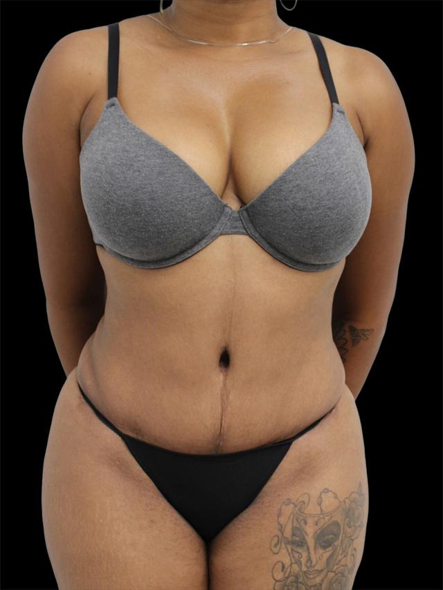 Mini Tummy Tuck after at NY Surgical Arts (Gordon Andan, MD) in Garden City, NY