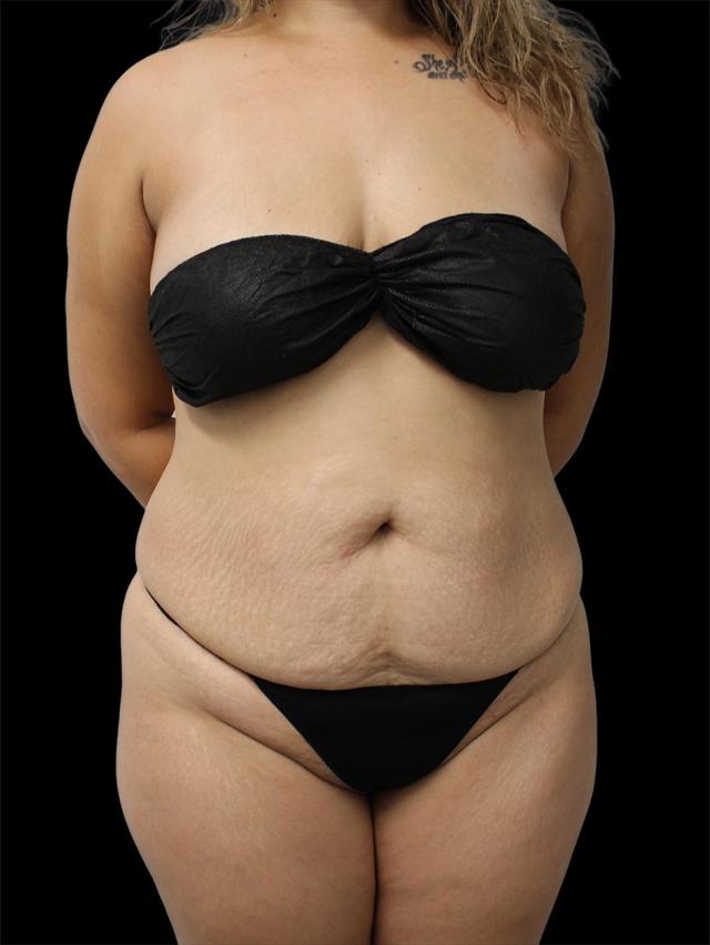 Mini Tummy Tuck before at NY Surgical Arts (Gordon Andan, MD) in Garden City, NY