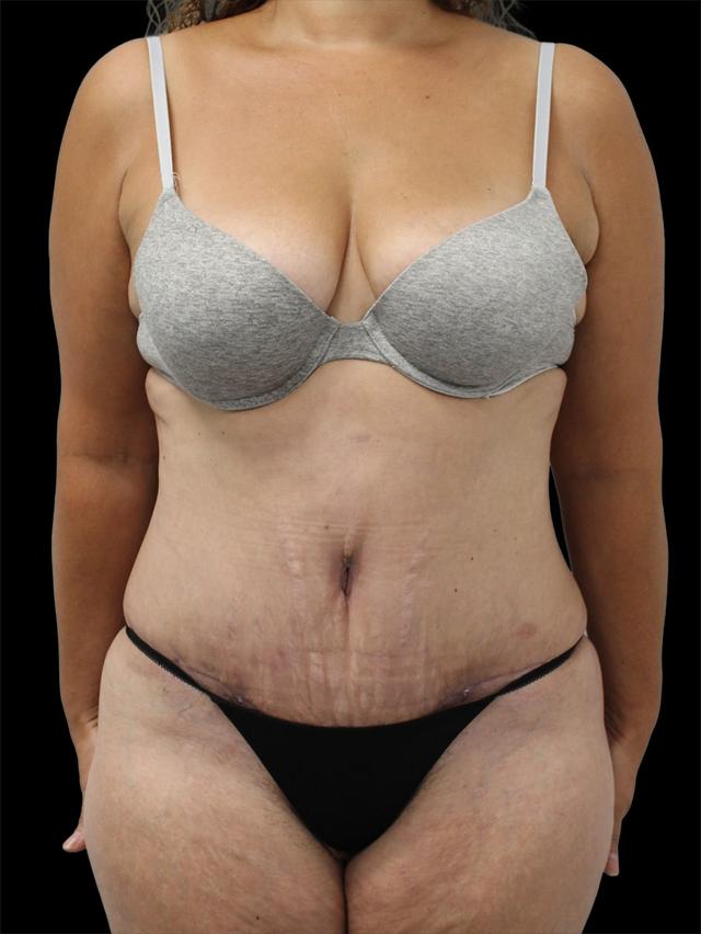 Mini Tummy Tuck after at NY Surgical Arts (Gordon Andan, MD) in Garden City, NY