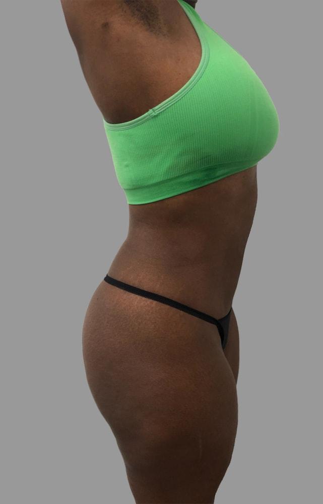 NY Surgical Arts (Gordon Andan, MD) liposuction after — Garden City, NY