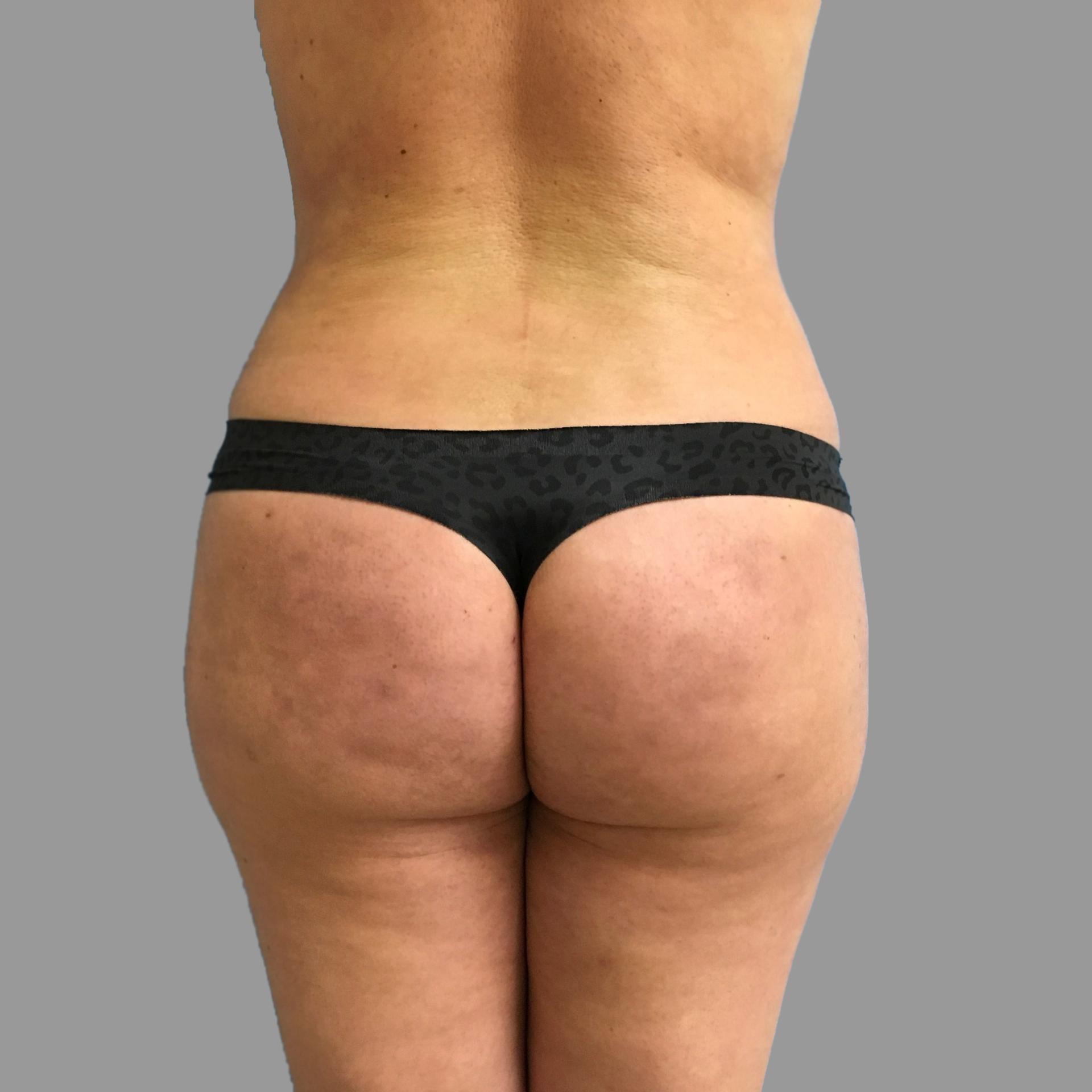 NY Surgical Arts (Gordon Andan, MD) bbl after — Garden City, NY