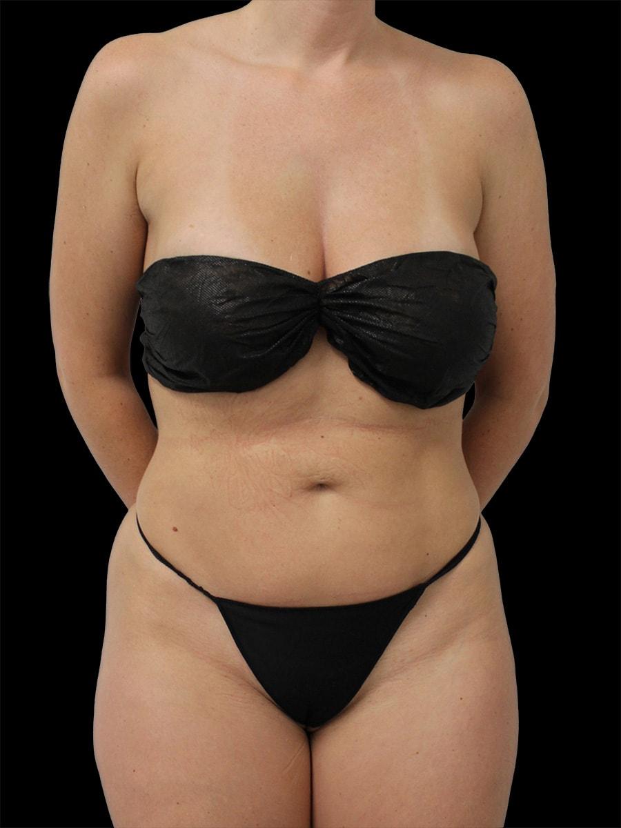 NY Surgical Arts (Gordon Andan, MD) liposuction after — Garden City, NY