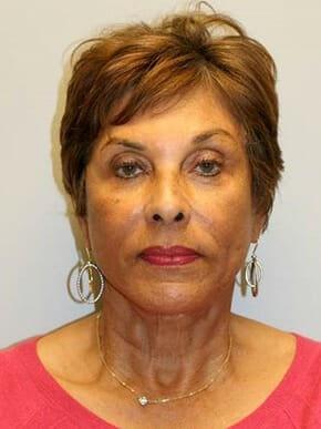 Hessler Plastic Surgery (Jill Hessler, MD) facelift after — Palo Alto, CA