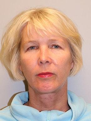 Hessler Plastic Surgery (Jill Hessler, MD) facelift after — Palo Alto, CA