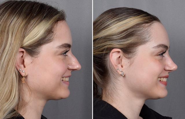 Rhinoplasty result at Vegas Facial Plastics in Las Vegas, NV