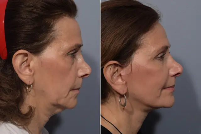 Facelift result at Vegas Facial Plastics in Las Vegas, NV