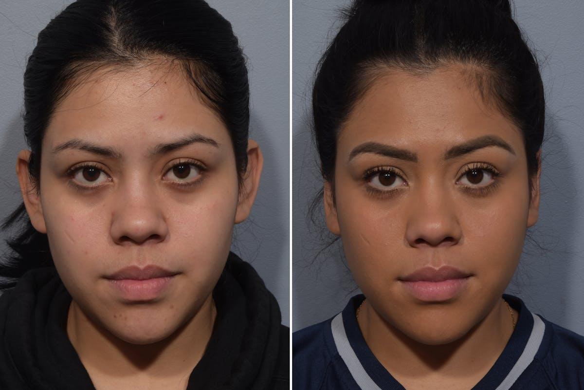 Vegas Facial Plastics otoplasty result — Las Vegas, NV