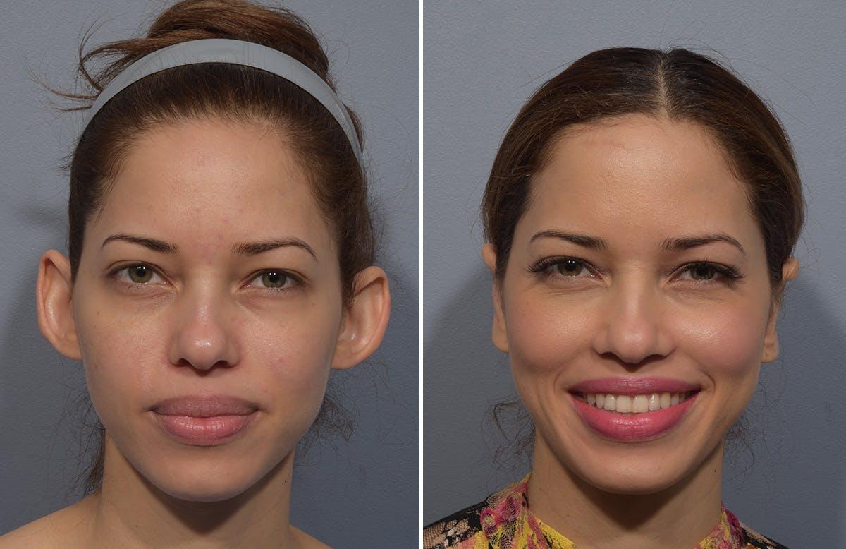 Vegas Facial Plastics otoplasty result — Las Vegas, NV