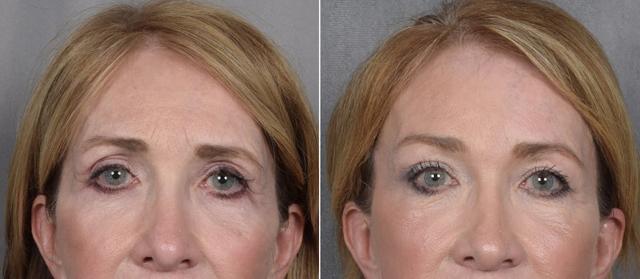 Brow Lift result at Vegas Facial Plastics in Las Vegas, NV