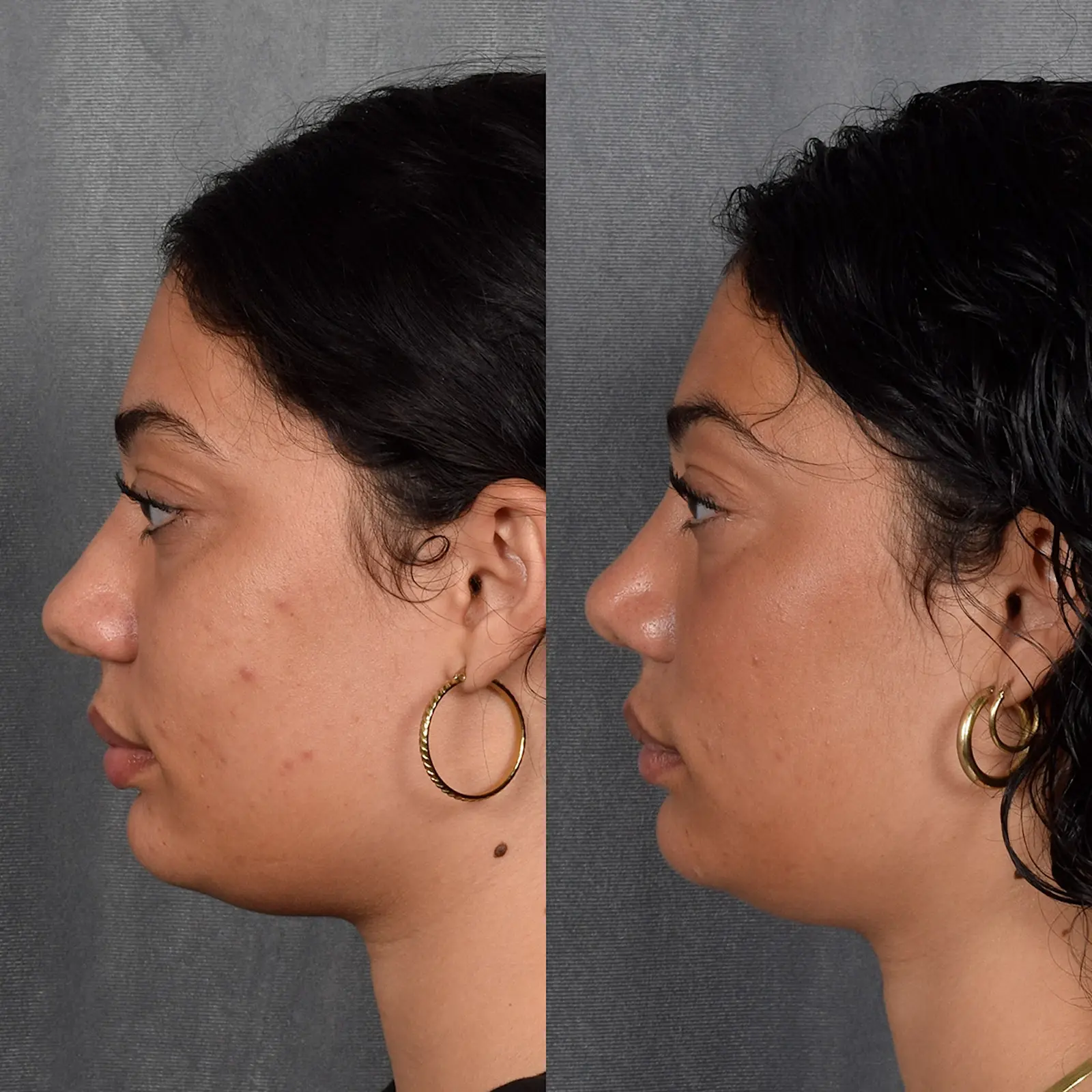 Vegas Facial Plastics rhinoplasty result — Las Vegas, NV