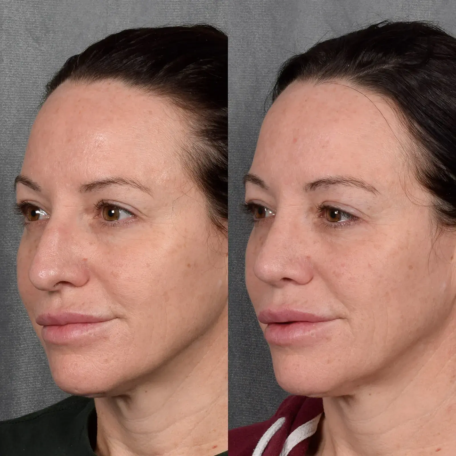 Vegas Facial Plastics rhinoplasty result — Las Vegas, NV