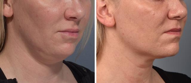 Neck Lift result at Vegas Facial Plastics in Las Vegas, NV