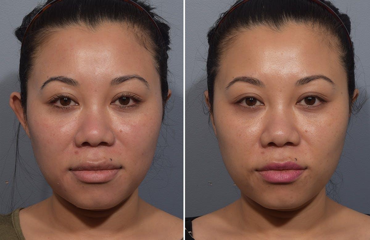 Vegas Facial Plastics otoplasty result — Las Vegas, NV