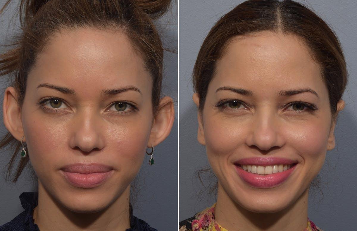 Vegas Facial Plastics otoplasty result — Las Vegas, NV
